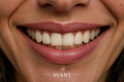 Avant